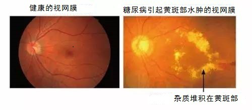 糖尿病引发的眼底病变