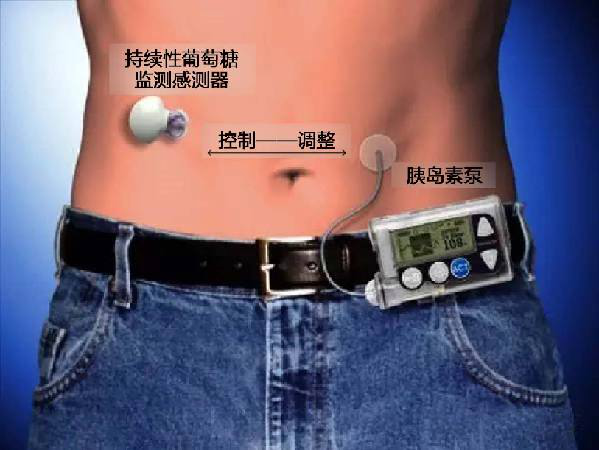 胰岛素泵（insulin pump）示意图